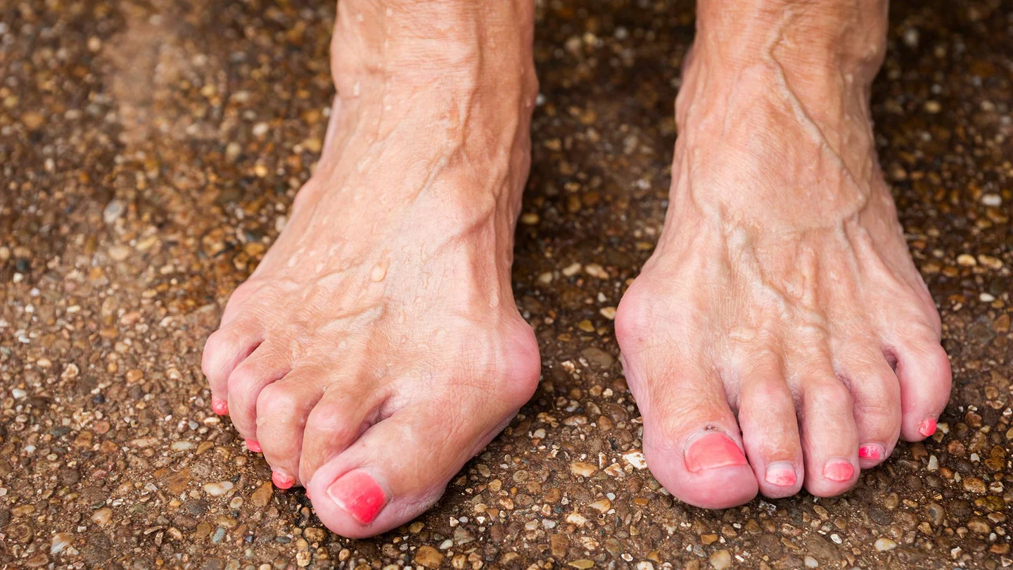Närbild på äldre kvinnofötter med synlig hallux valgus på stortårnas innerleder